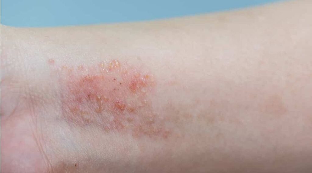 Eli Lilly tem aval de regulador para nova forma de uso de remédio para dermatite atópica