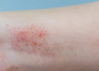 Eli Lilly tem aval de regulador para nova forma de uso de remédio para dermatite atópica